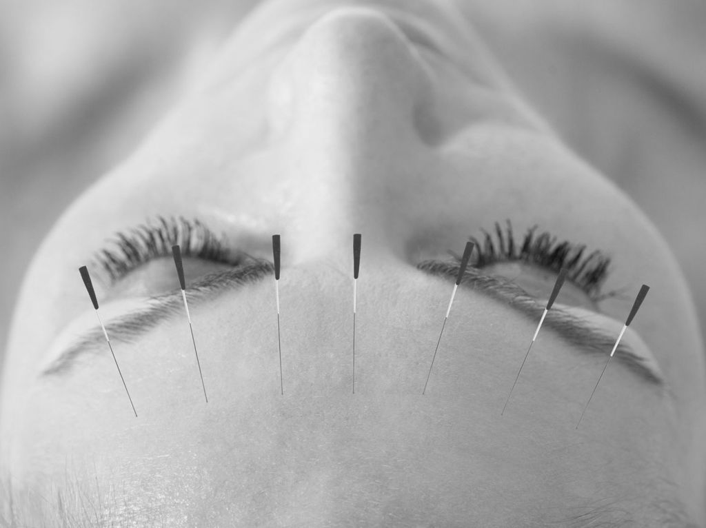 Woman with acupuncture needles in her forehead