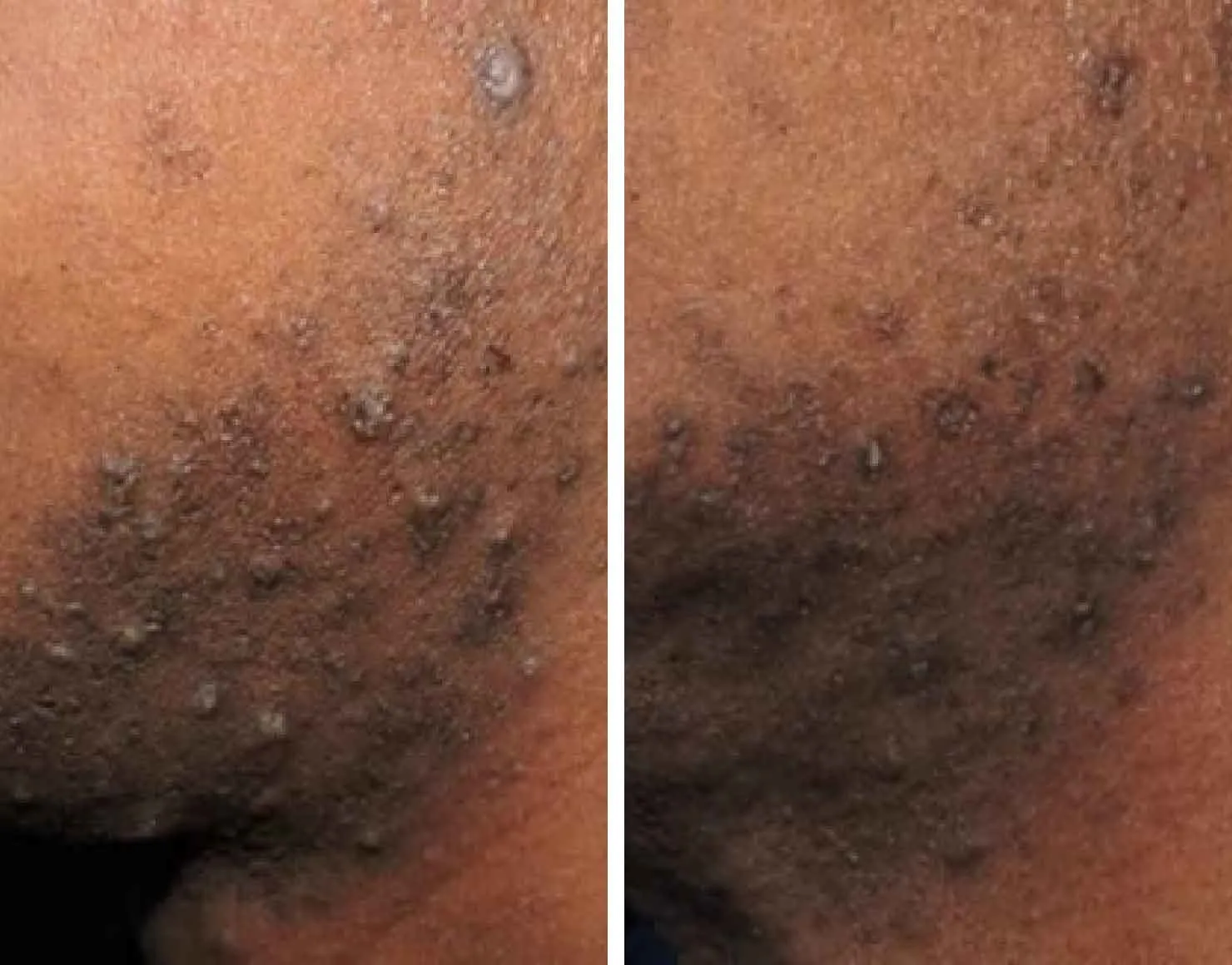 Forskning visar att Gillette SkinGuard Sensitive minskar rakfinnar med mer än 60 % 