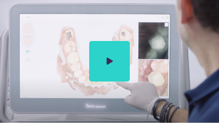 Watch Dr. Oliver Boujenah, DDS and iTero Element® 5D Imaging System video