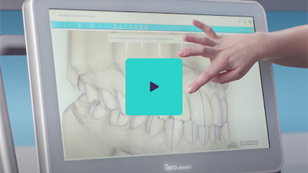 Watch Invisalign Outcome Simulator video