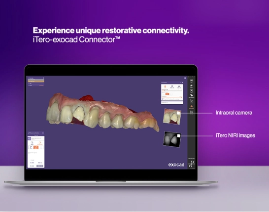 iTero-exocad integrations