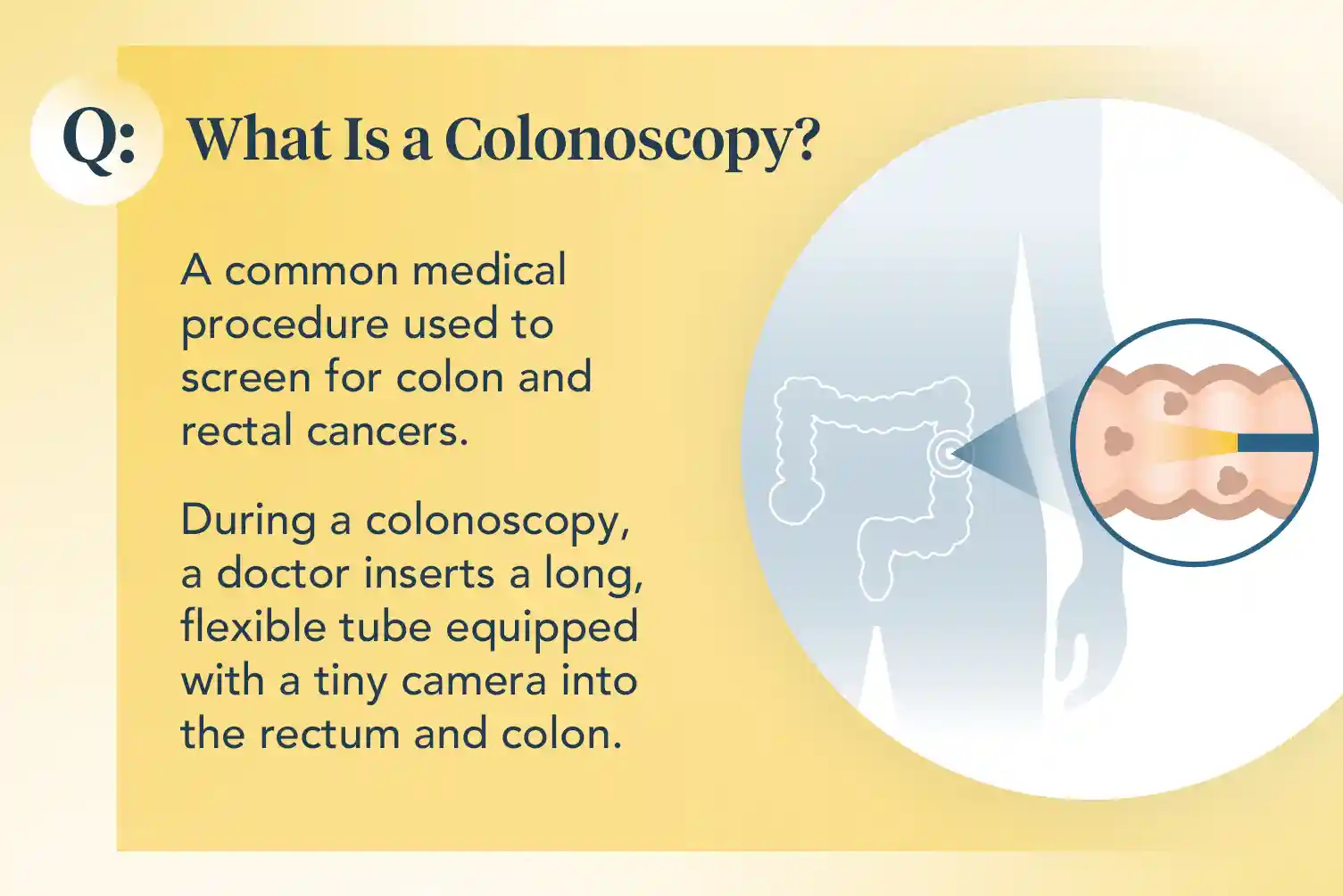 March-2024 Colonoscopy Resource-Center-1505x1005 What-is-a-Colonoscopy