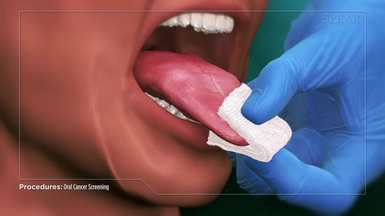 oral cancer screening.webp