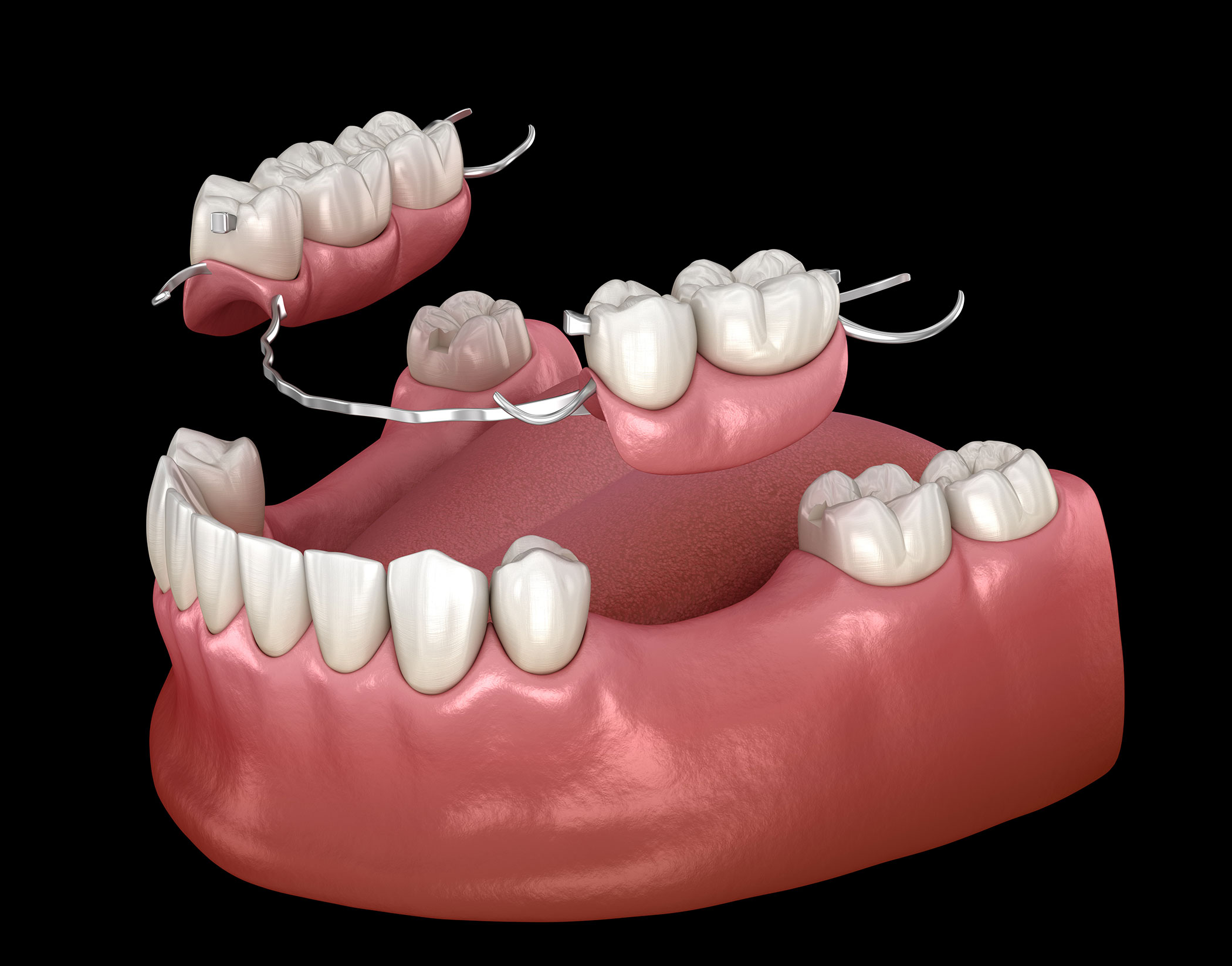 partial-denture.jpg