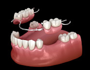Removable Partial Dentures Removable Partial Dentures