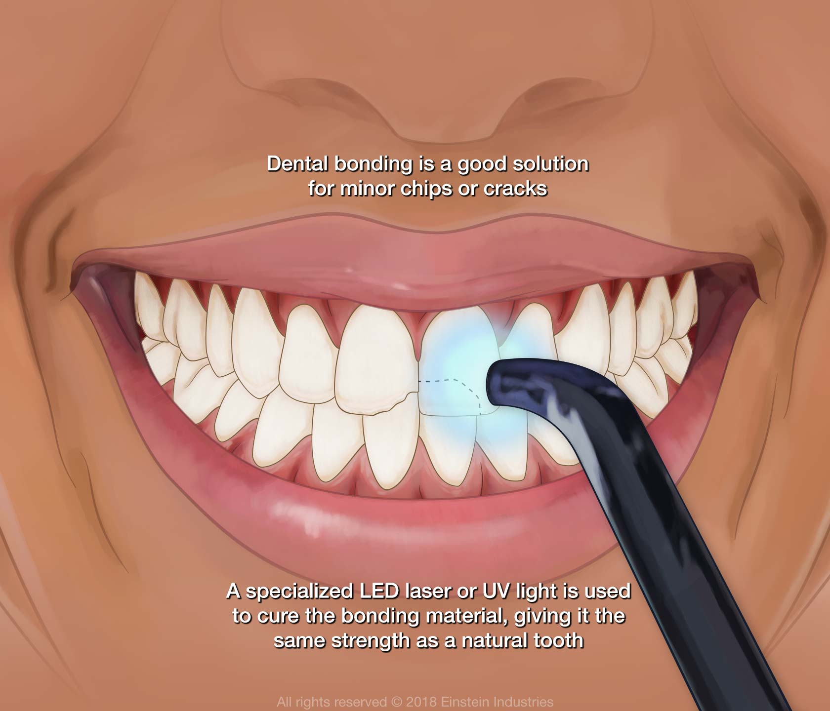 Tooth bonding is the application of composite resin to the surface of the tooth to repair it. It’s a simple, inexpensive cosmetic dental procedure that is usually completed in a single visit.
Tooth bonding is one of the easiest and least expensive cosmetic dental procedures. There are lots of dental issues that bonding can correct. However, tooth bonding is most often used to correct chipped or discolored teeth. Bonding can also be used to close the large spaces between teeth, change the shape of teeth or make teeth appear longer. In some cases, bonding is used in place of amalgam or metallic fillings to protect the exposed root of a tooth with receded gums.