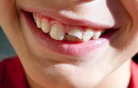 It is common for people to damage a tooth while playing sports or getting into an accident. It is likely that the tooth will become cracked or chipped. As long as the tooth structure remains in place, we can typically correct it with various dental treatment options. There are multiple ways that we can restore a patient's teeth. Some of which include dental veneers and a dental crown. Both are excellent options and can restore your tooth to full functionality while keeping it natural looking. As an emergency dental facility, we can provide you with information on what your options are and the best way to restore your tooth while achieving the goals that you have for your smile. 
