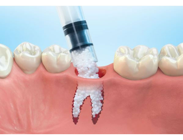 bone grafting.jpg