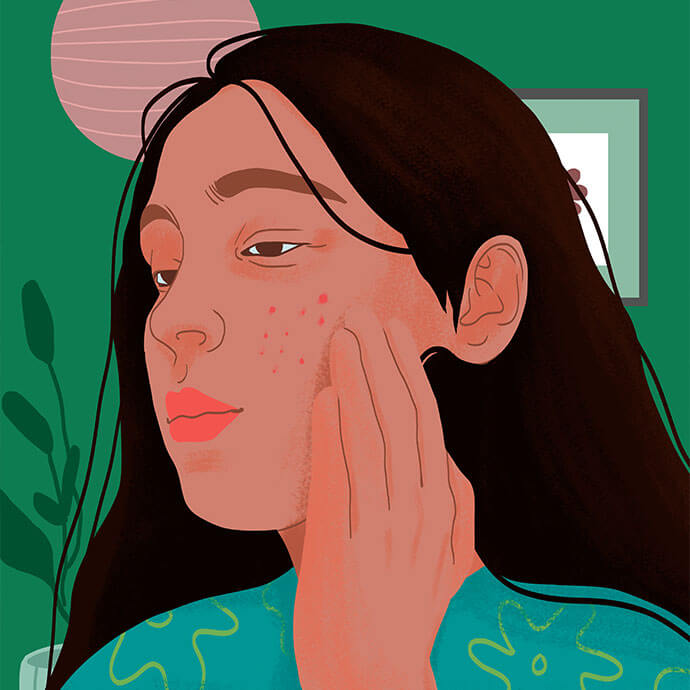 A closer look at Irregular Periods Acne Causes