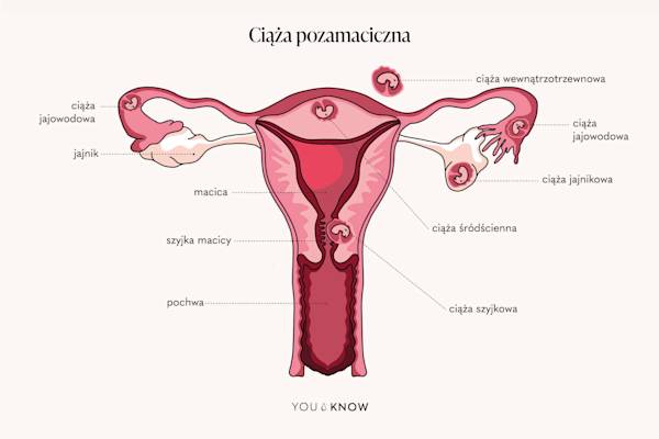 ilustracja - ciąża pozamaciczna