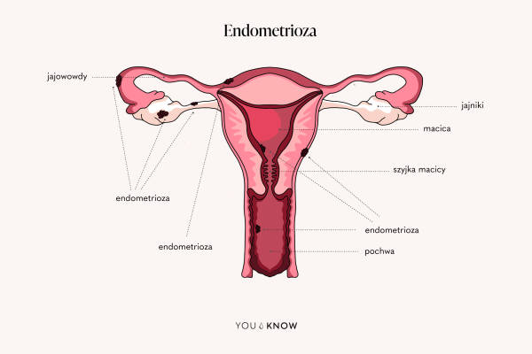 ilustracja endometrioza - jak wygląda