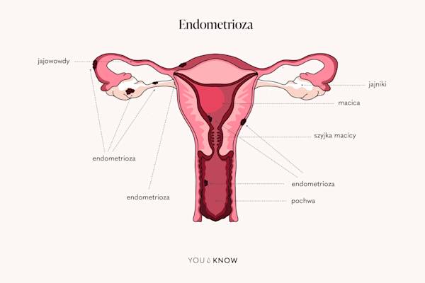 Endometrioza poprawione
