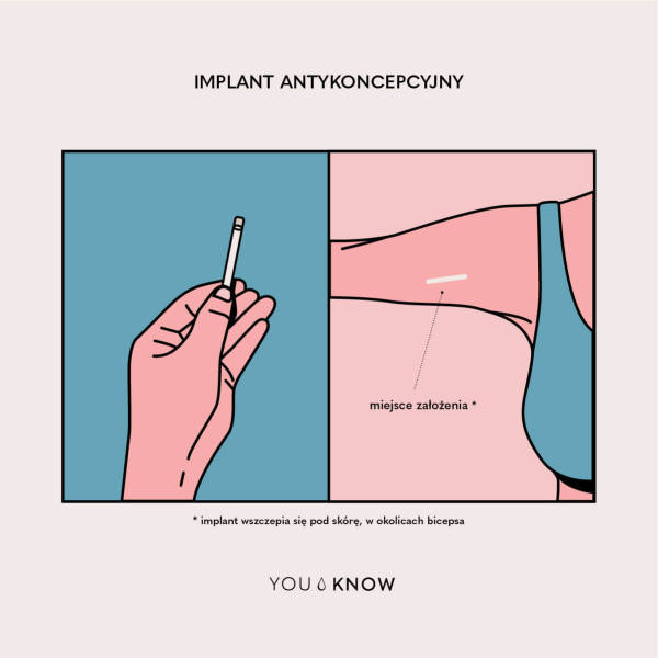 Ilustracja implantu antykoncepcyjnego i prezentacja umiejscowienia go w ciele (na ramieniu)