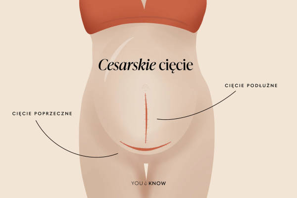 ilustracja cesarskie cięcie - cięcia na brzuchu