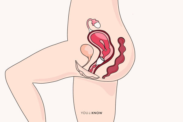 ilustracja kubeczek menstruacyjny w pochwie