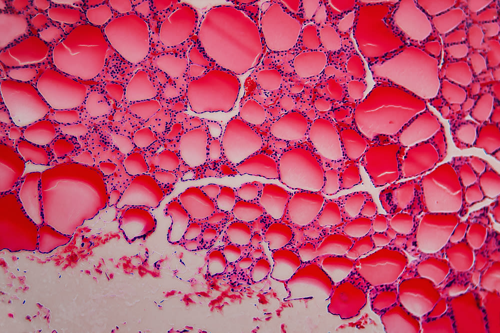 Resultado de una biopsia