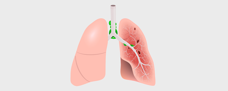 Metabolic analysis brings to light ignored lung disease 