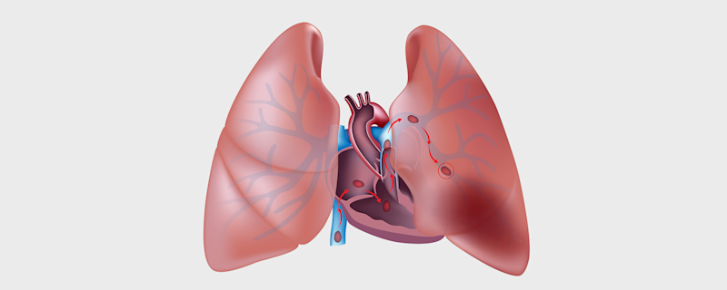 Metabolic analysis detects life-threatening, undiagnosed lung condition.