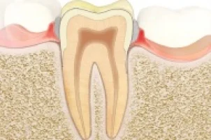 Zahnfleischentzündung (Gingivitis)