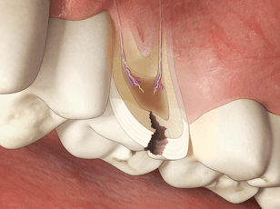 Kariesentstehung, Phase 3, Dentinkaries