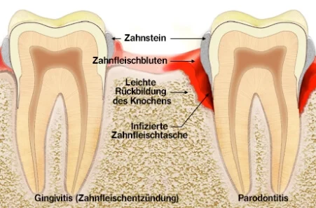 Von der Zahnfleischentzündung (Gingivitis) zur Parodontose (Parodontitis)