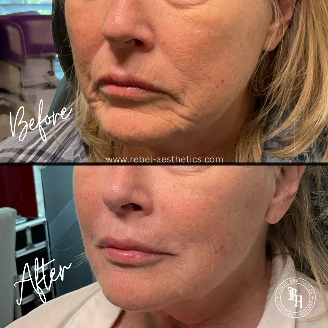 Dermal Filler (Juvederm)