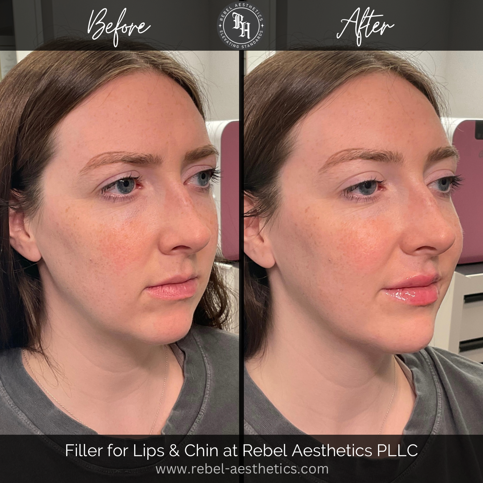 Dermal Filler (Juvederm)