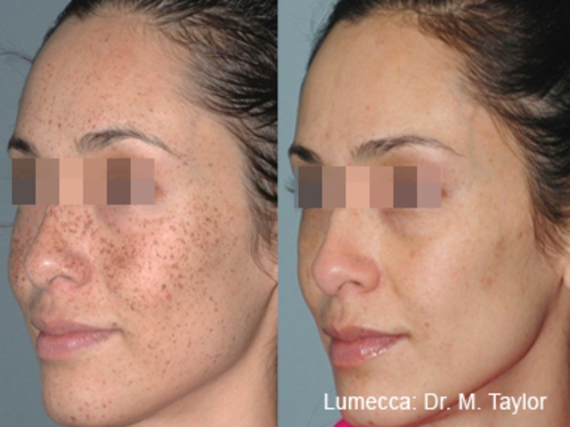 Before & After - Lumecca IPL Stock Image