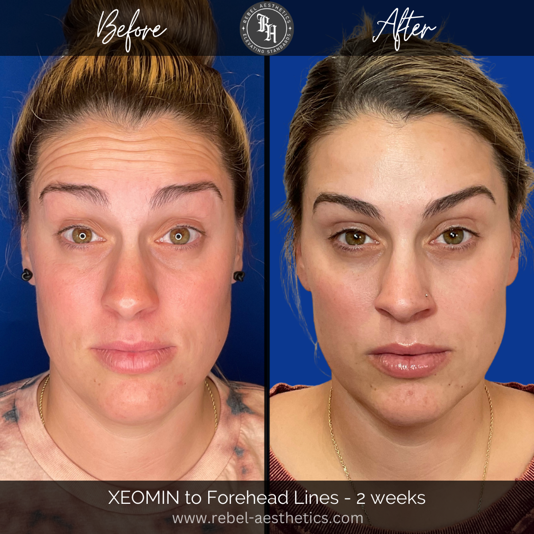 Tox Injections (Botox/Xeomin)