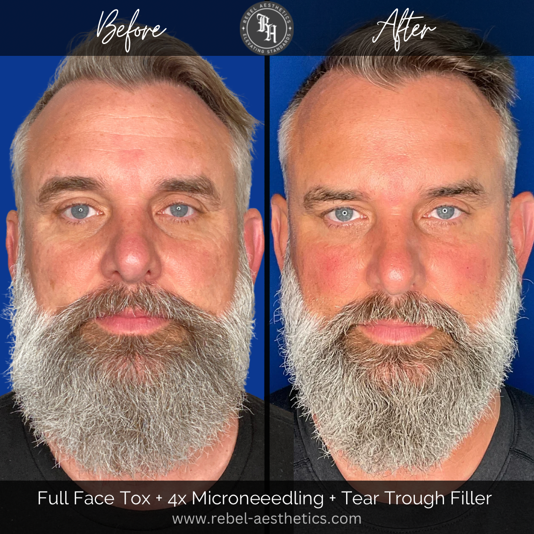 Microneedling