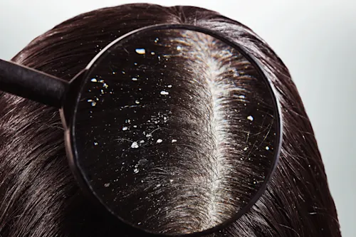 أفضل 8 أنواع شامبو للقضاء على القشرة