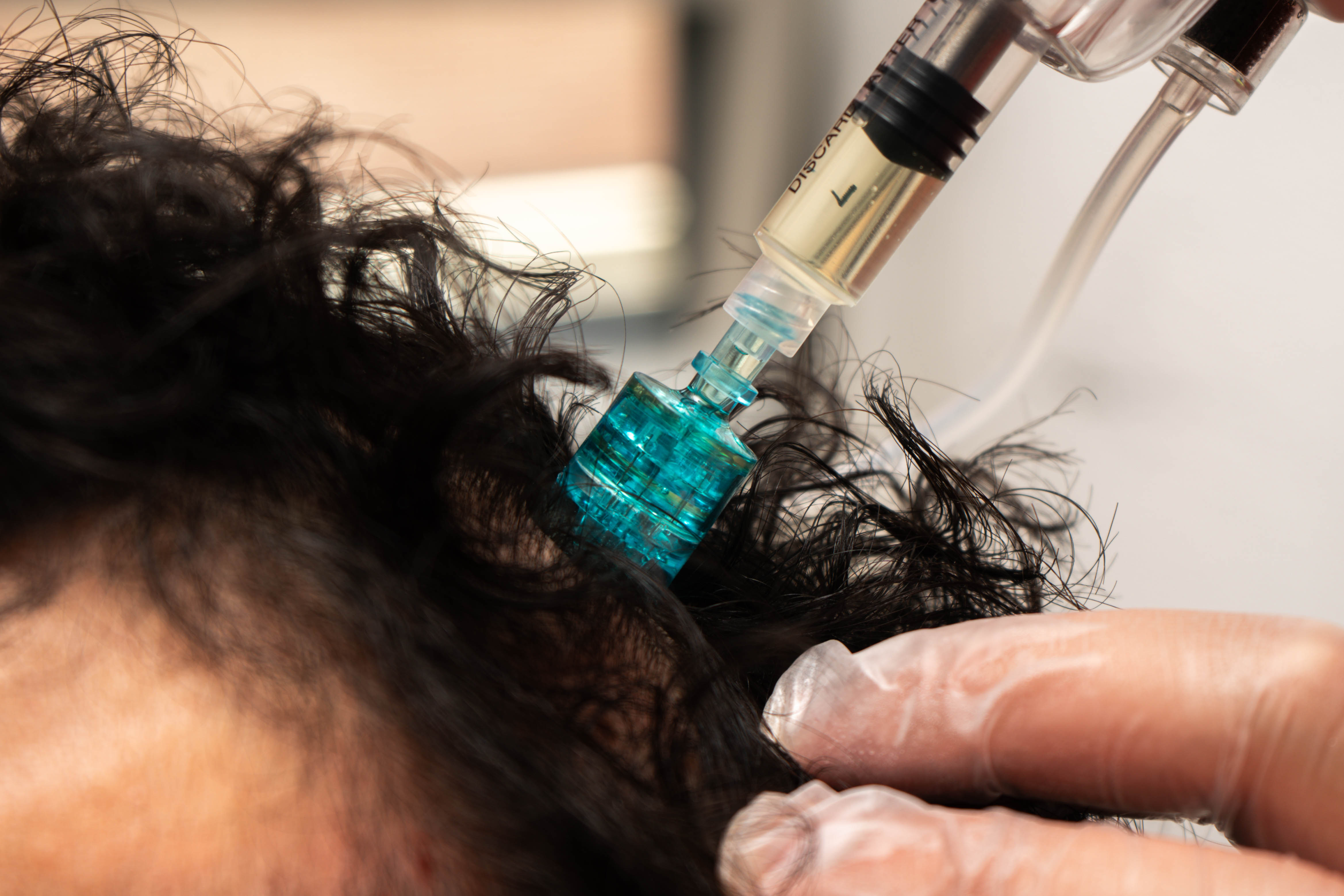 Wat is Mesotherapie en Waarom is het zo Populair bij Haaruitval?