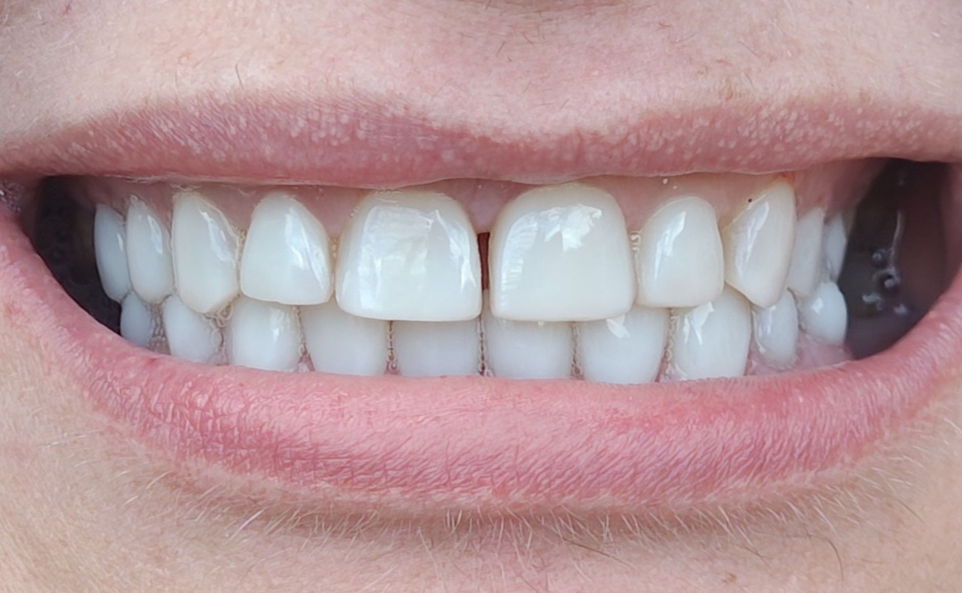 teeth after