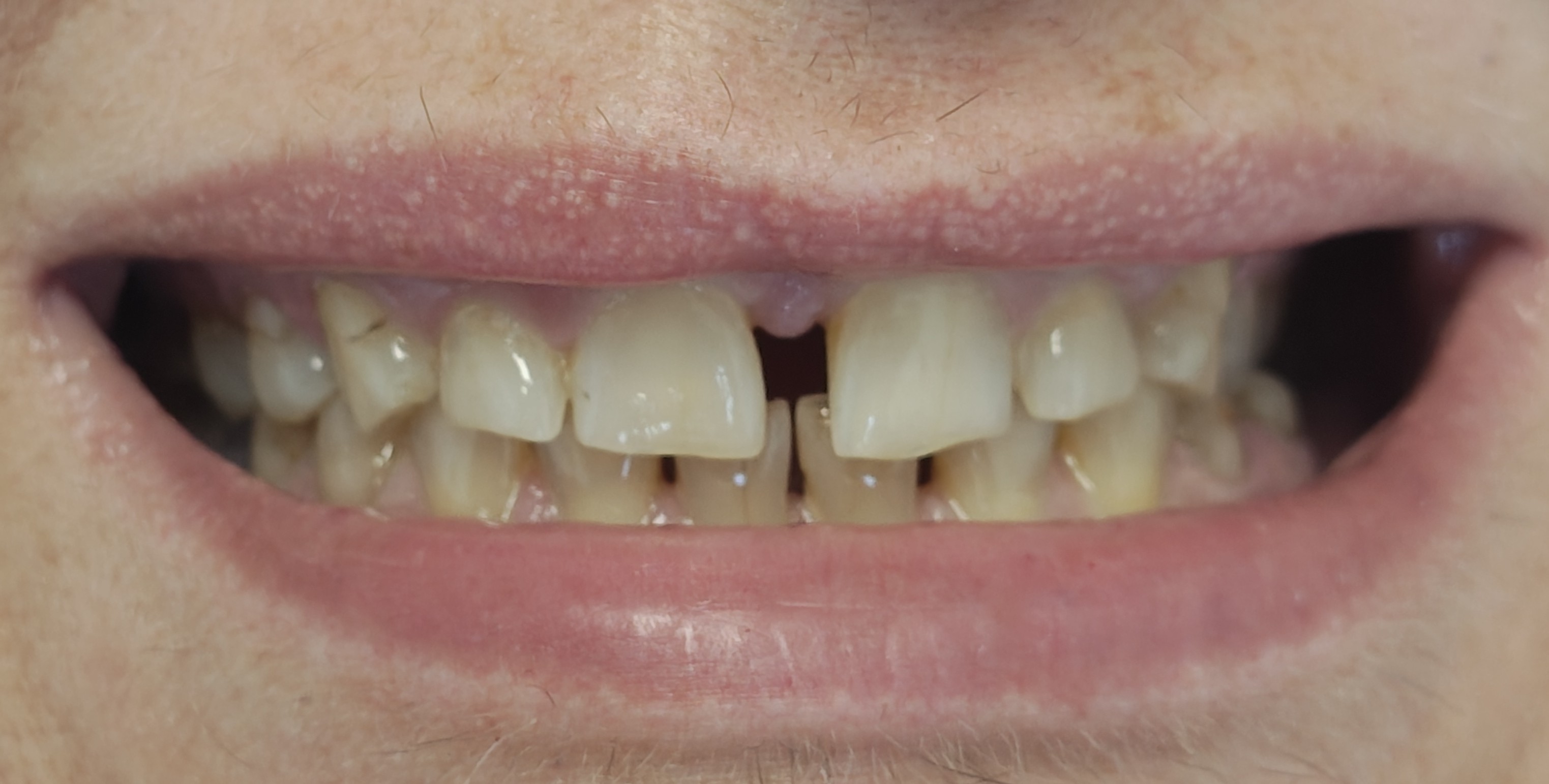 teeth before