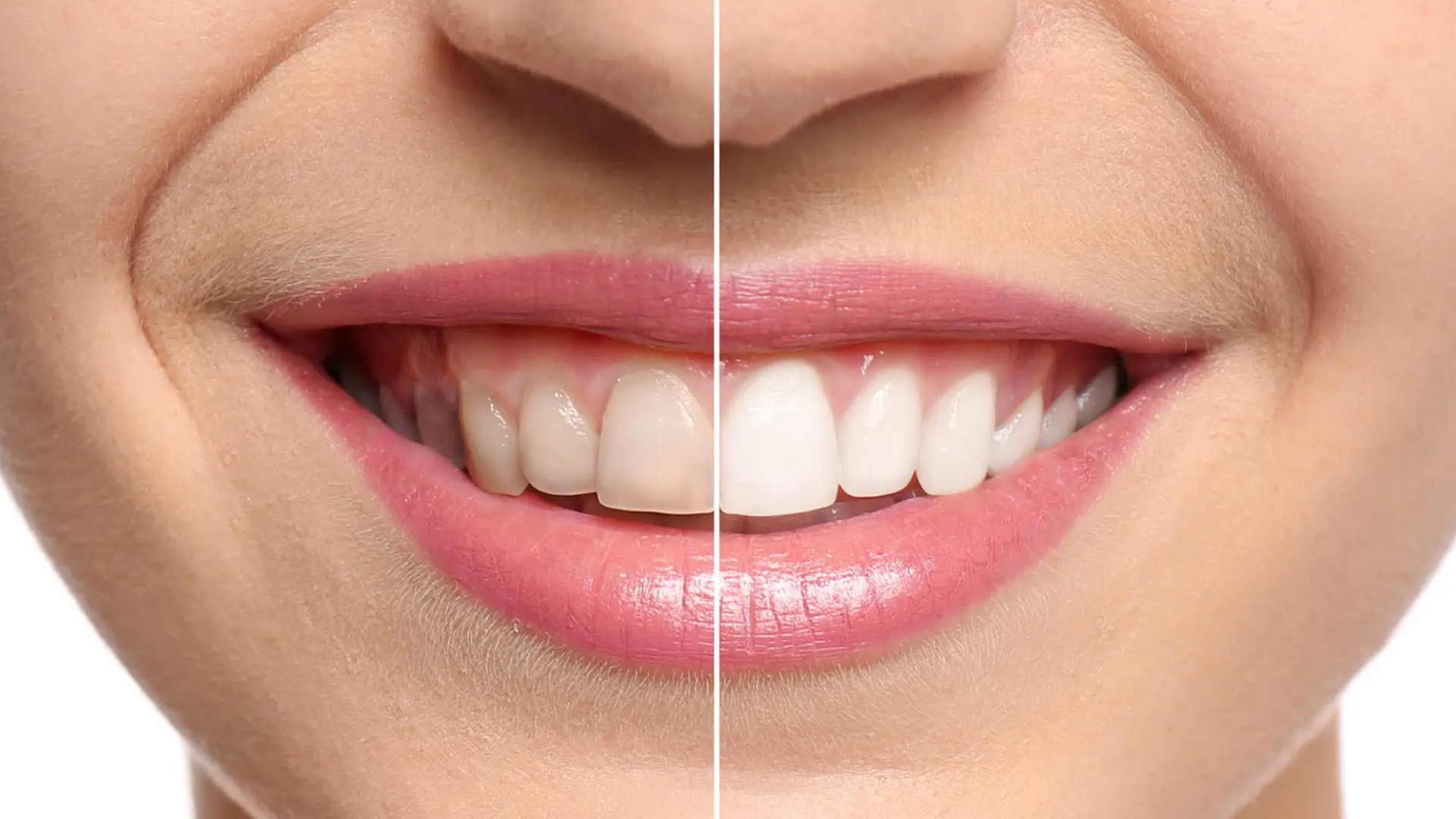 How Can You Get Whiter Teeth Safely