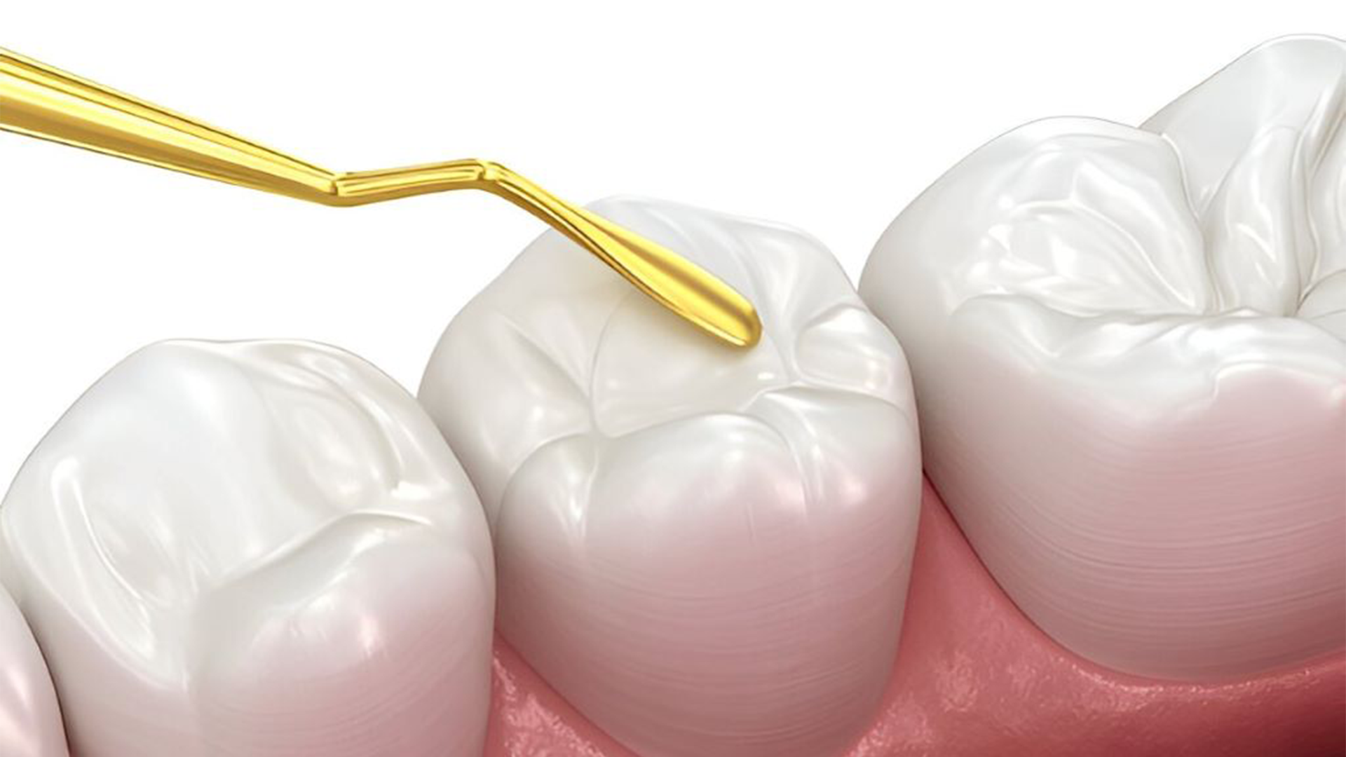 Tooth Filling Cost in Canberra