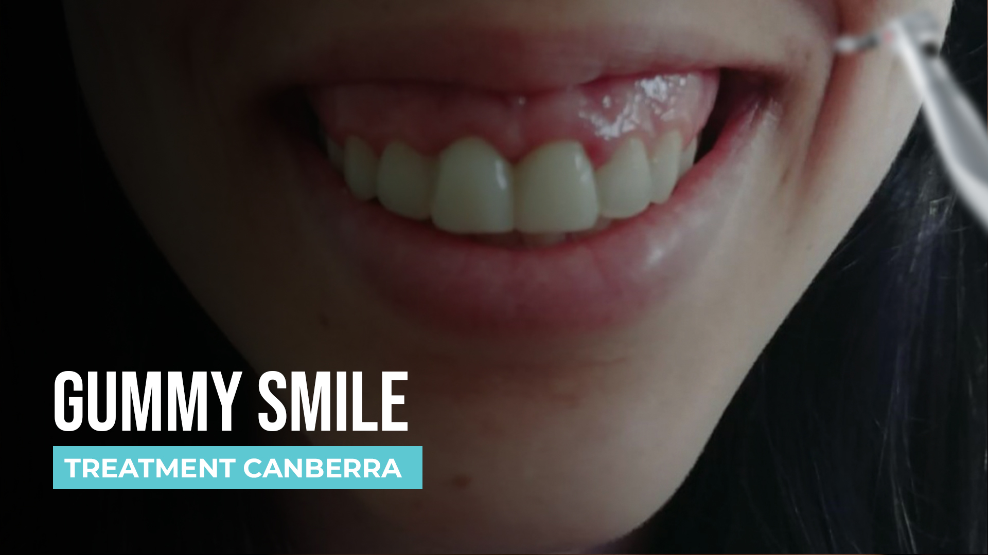 How to Fix a Gummy Smile: Causes and Effective Treatment Options
