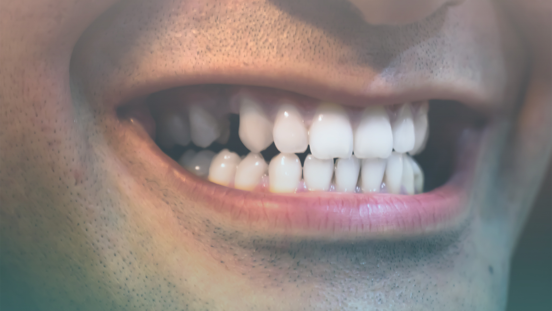 Teeth Grinding Canberra
