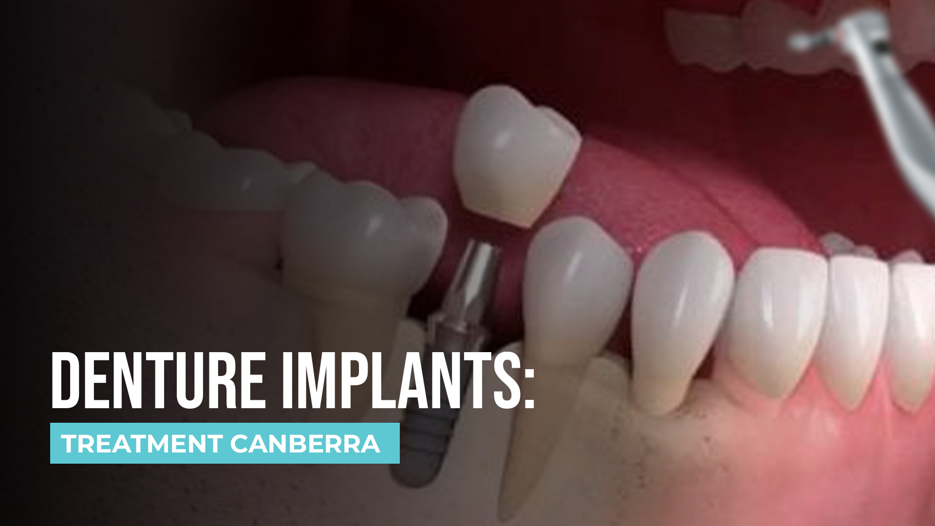 Guide to Denture Implants: How They Work and Whether They Are Right for You