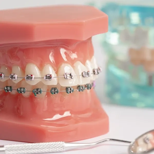 Dental Braces Canberra