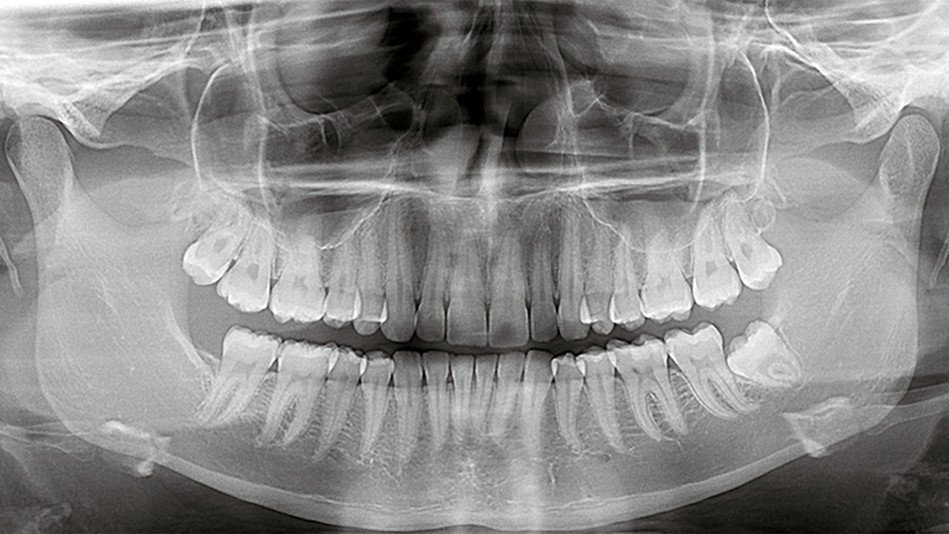 What Is a Dental OPG?