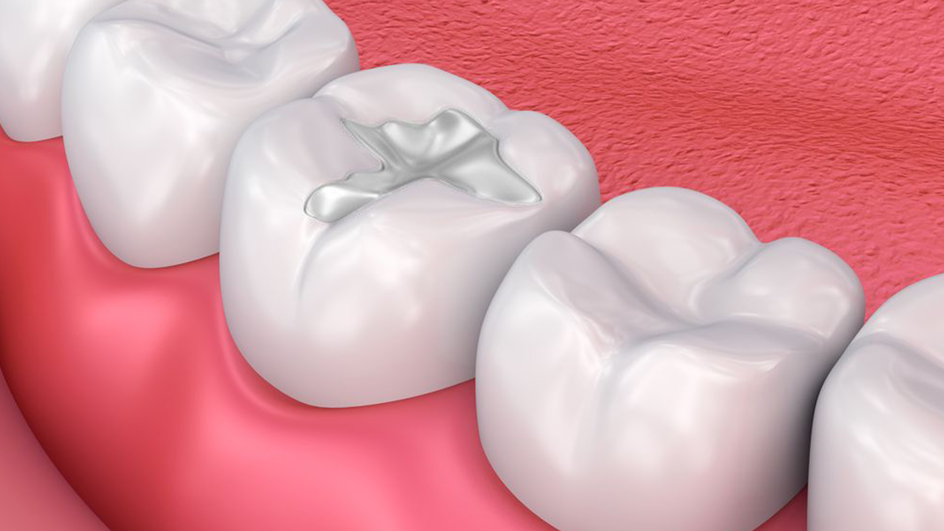 White Tooth Filling Cost in Canberra: A Clear Price Guide 