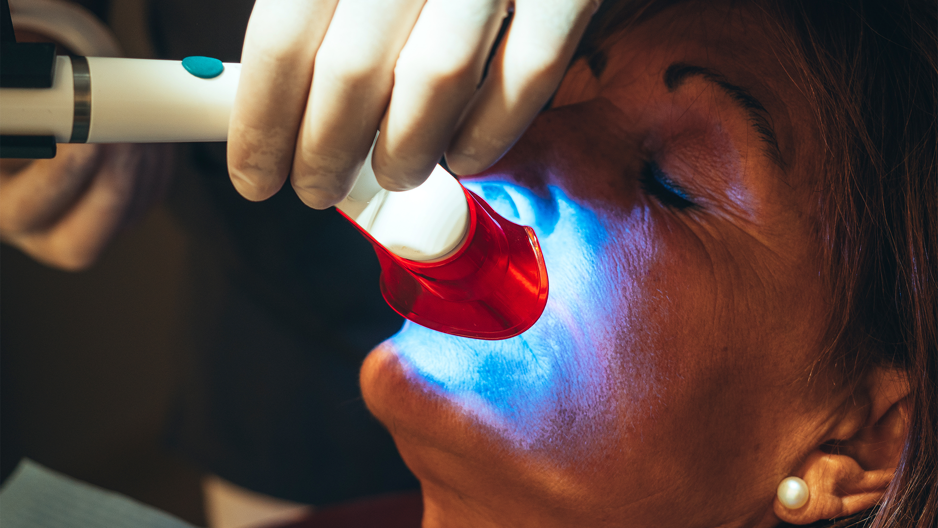 Teeth Whitening Canberra: What Actually Works — and What to Expect