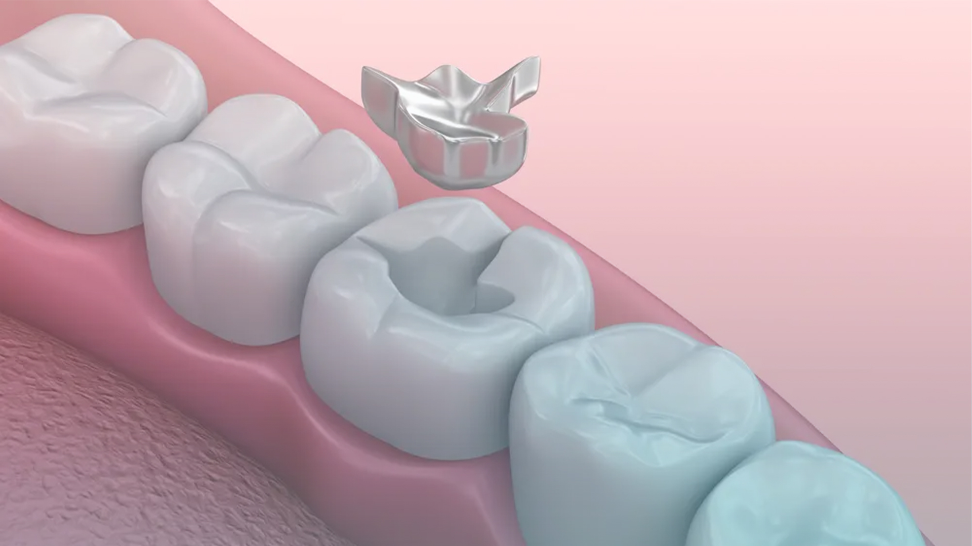 Dental Fillings Canberra