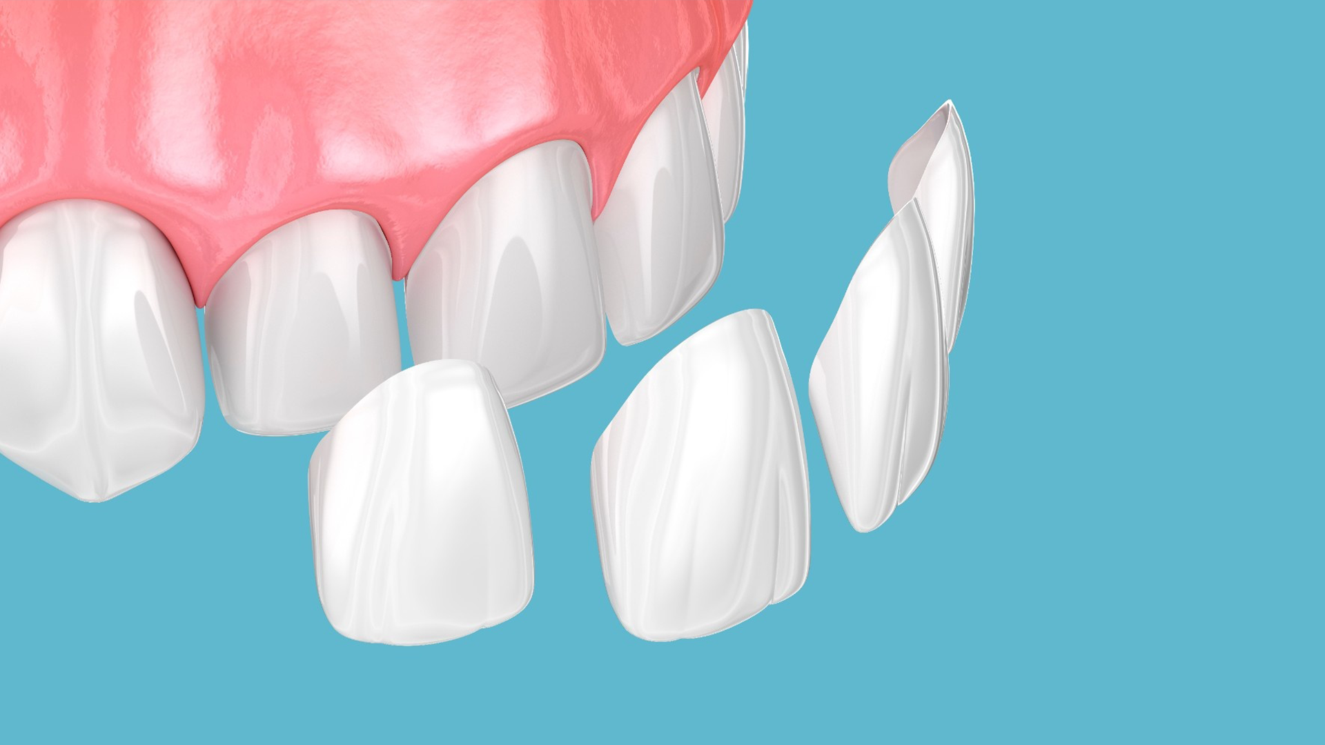 Porcelain Veneers Cost in Canberra: What You'll Really Pay