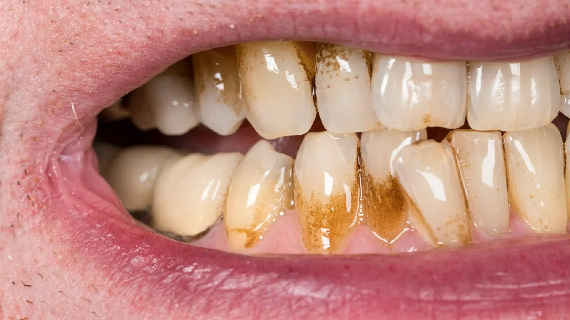 How to Clean Stains From Teeth