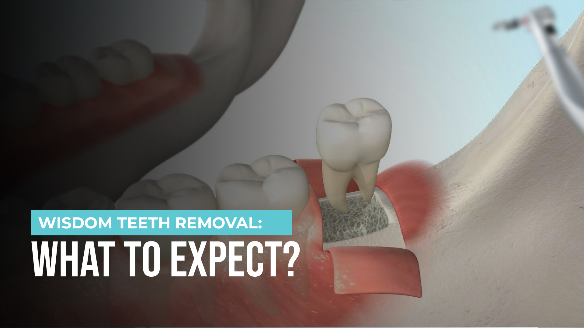 Wisdom Teeth Removal Recovery: What to Expect Day by Day