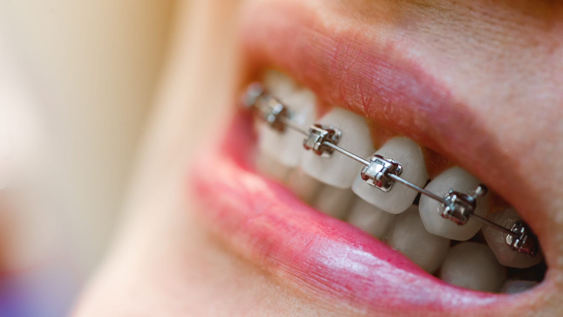 Metal Braces Cost in Canberra, Explained: Where the Money Goes