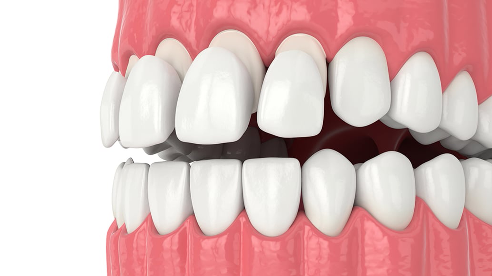 Composite Veneers Cost in Canberra: The Full Picture
