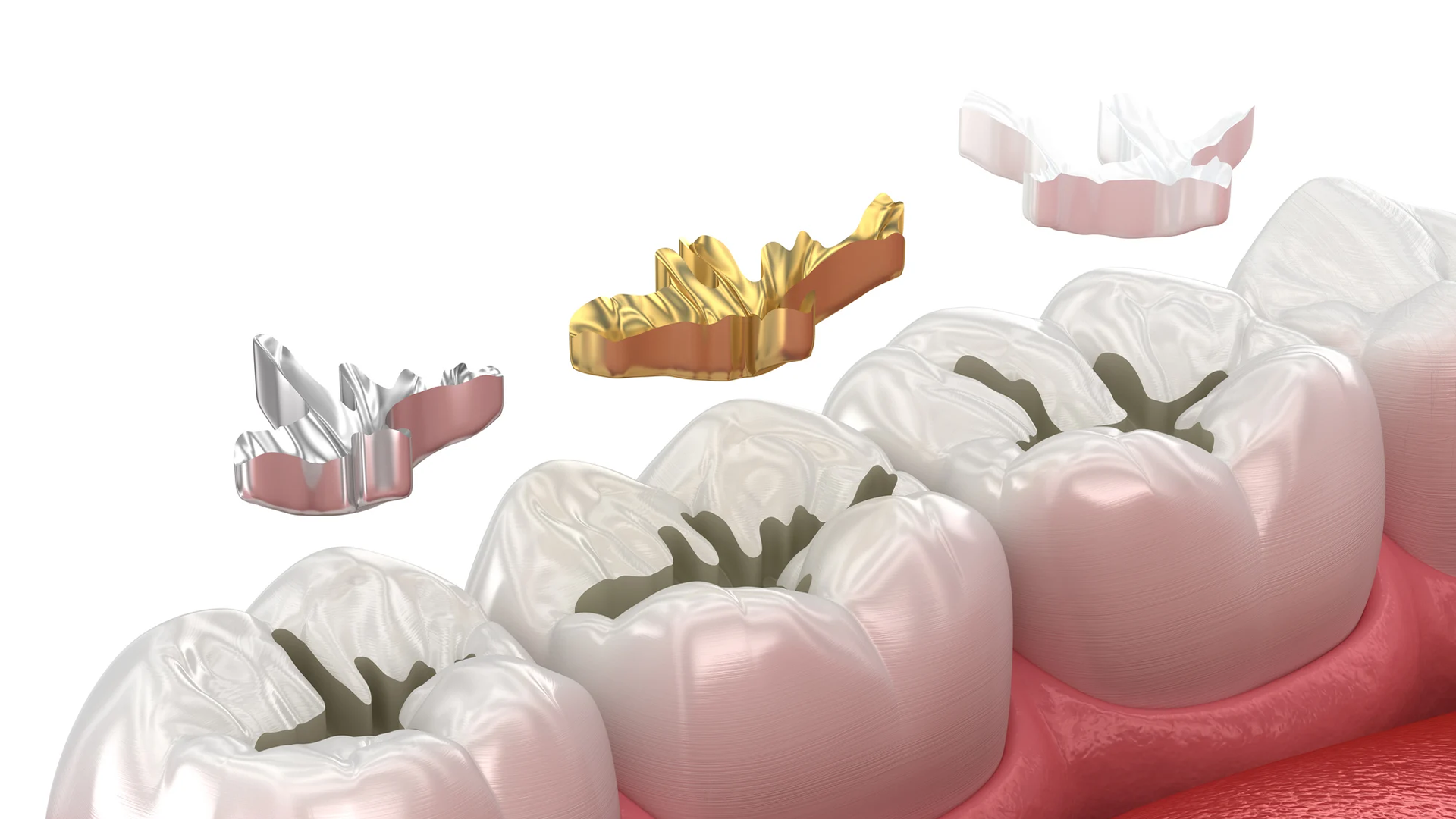 Signs You Need a Filling, and the Symptoms of a Cavity
